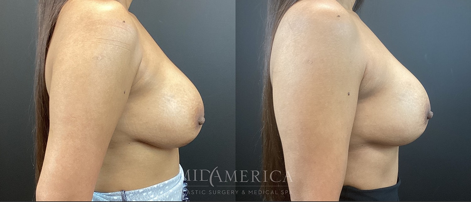 Implant Exchange Before & After