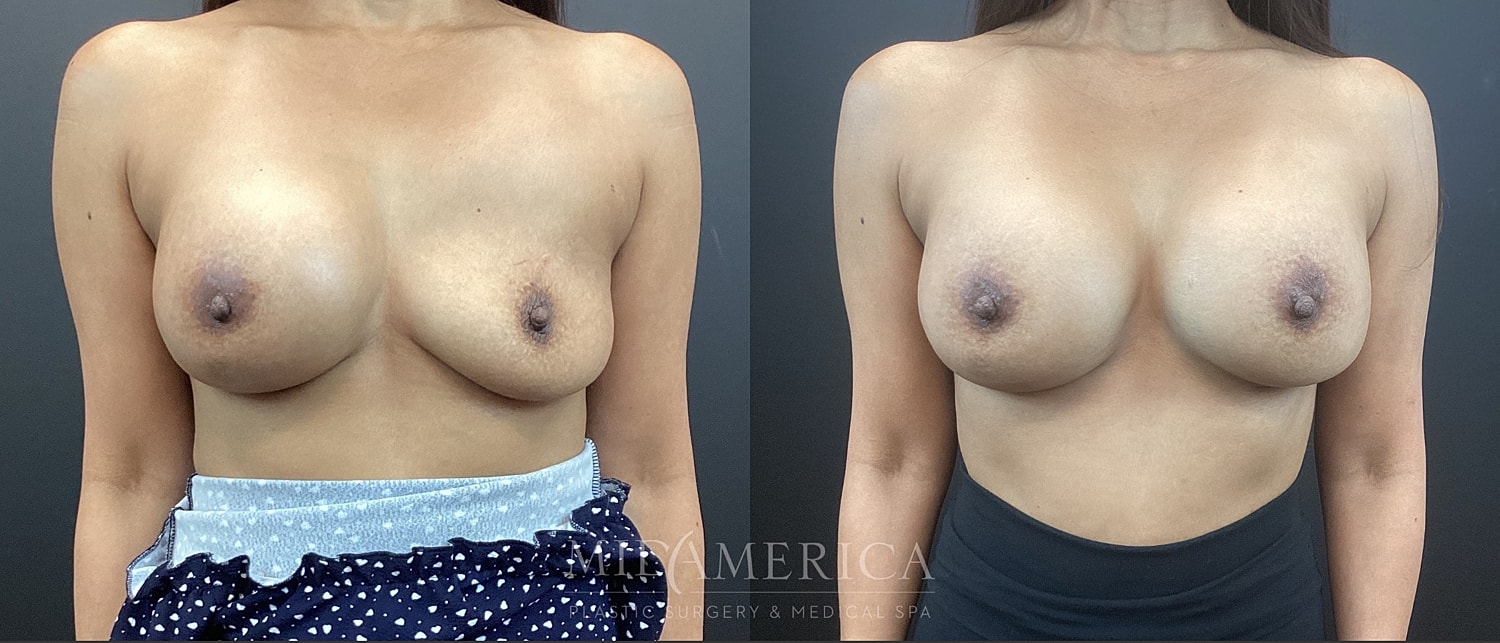 Implant Exchange Before & After