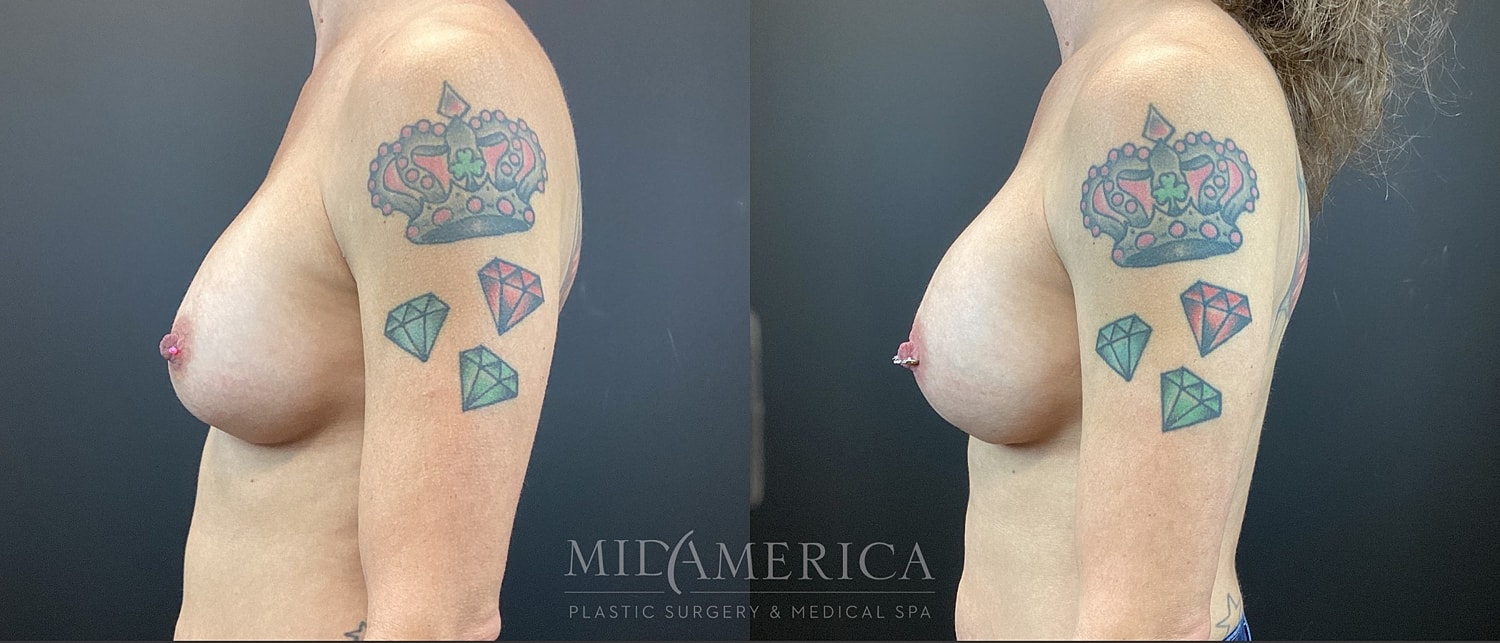 Implant Exchange Before & After