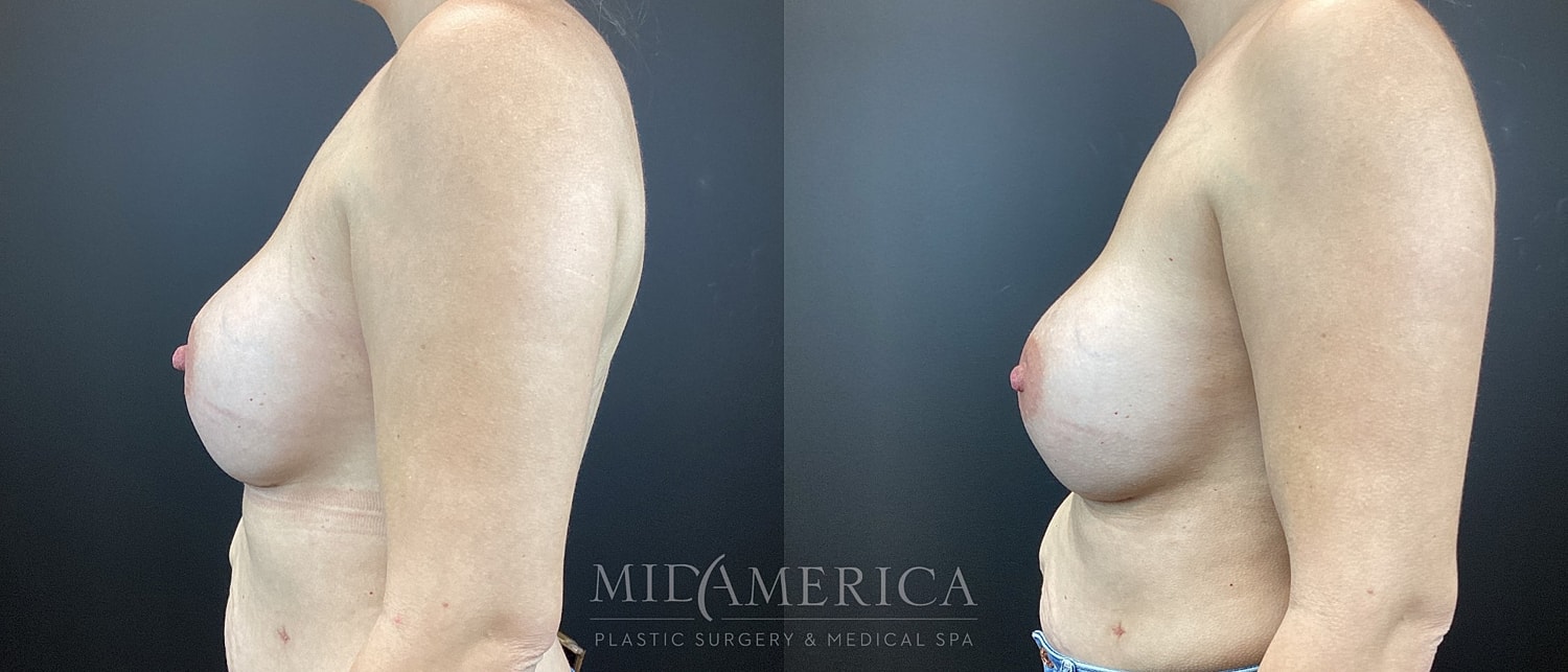 Implant Exchange Before & After