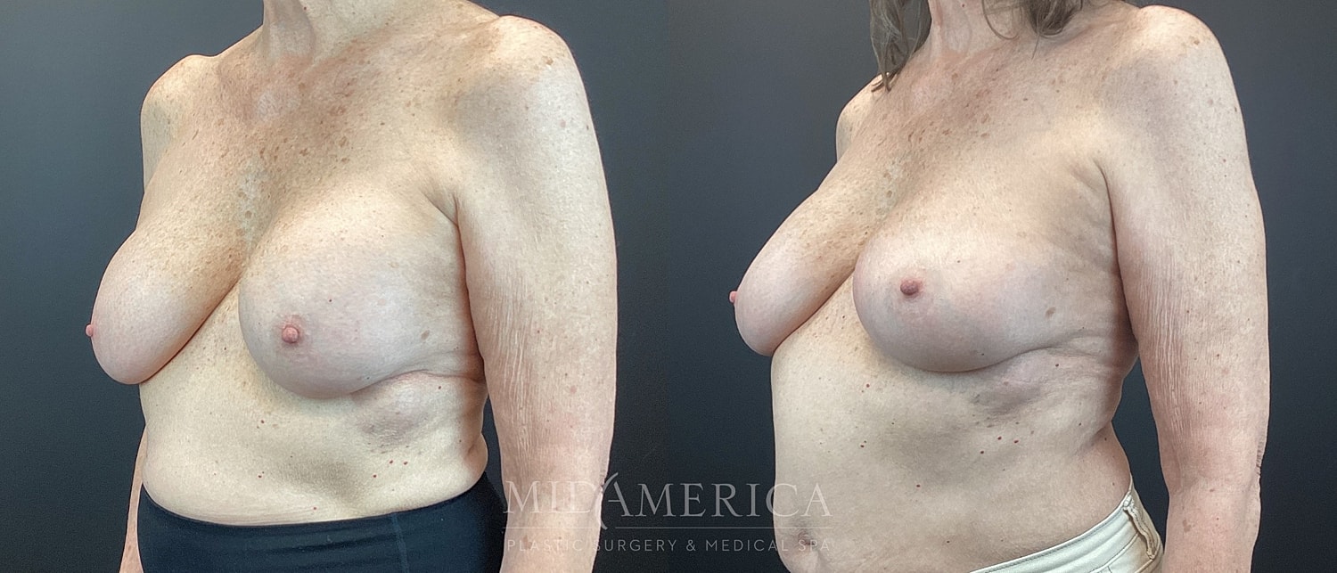 Before and after plastic surgery transformation photo