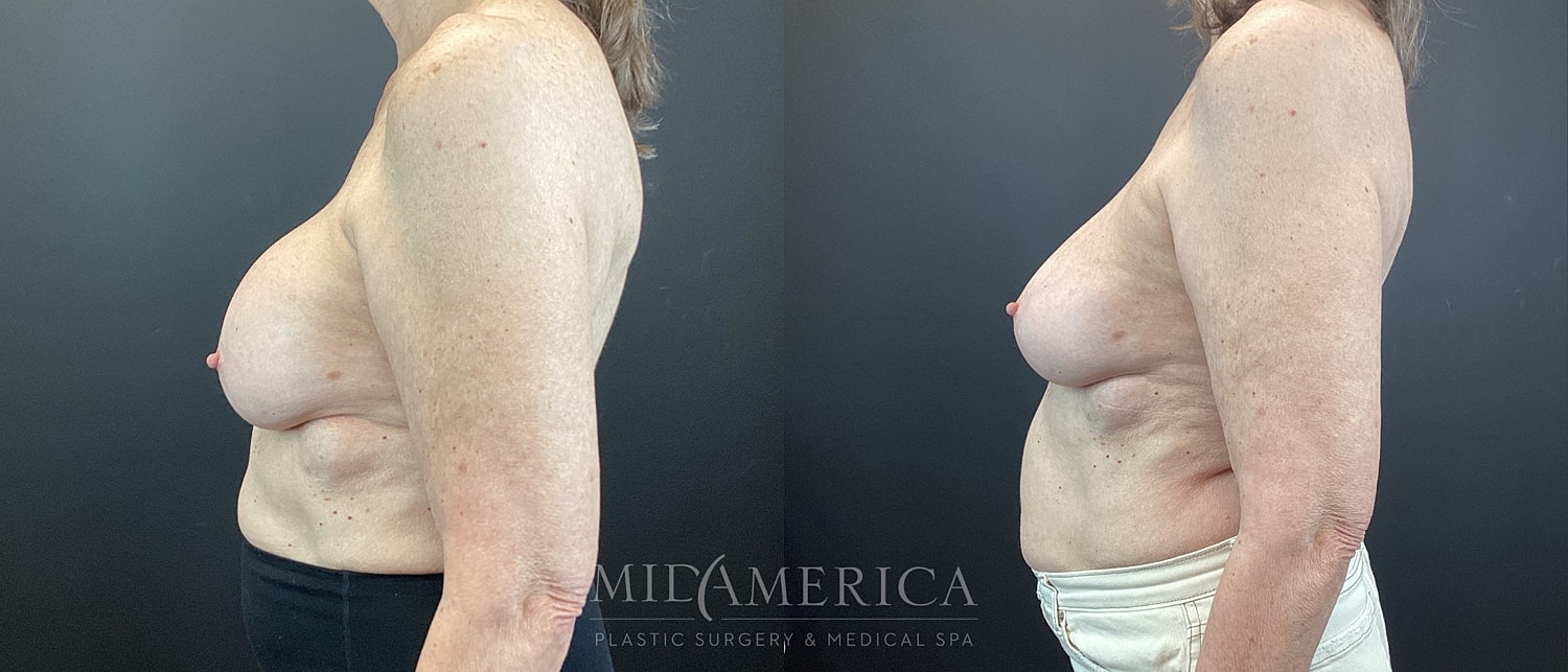 Before and after breast enhancement comparison.