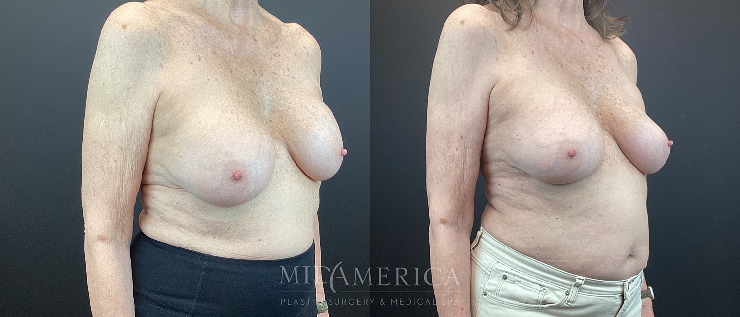 Before and after breast surgery comparison image.