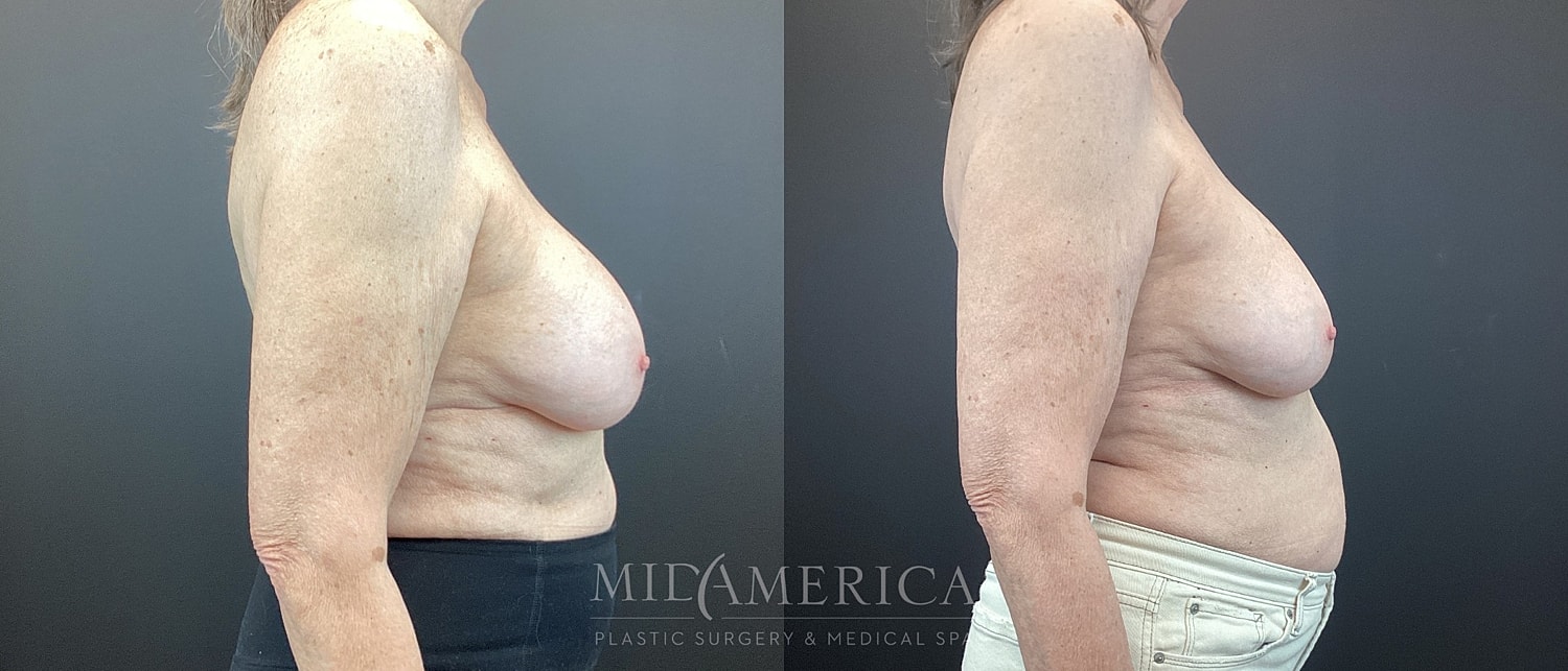 Side profile comparison of youthful breast appearance.