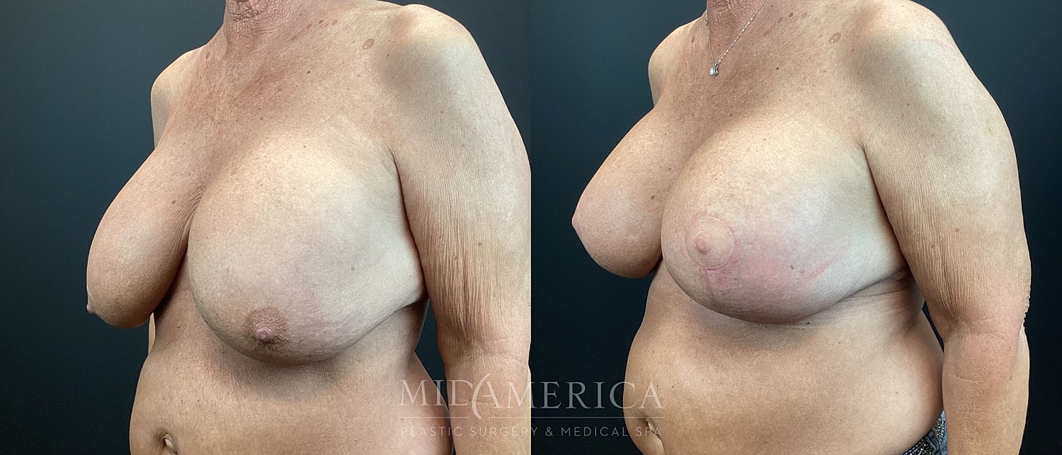 Implant Exchange Before & After