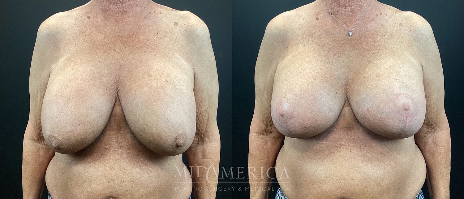 Implant Exchange Before & After
