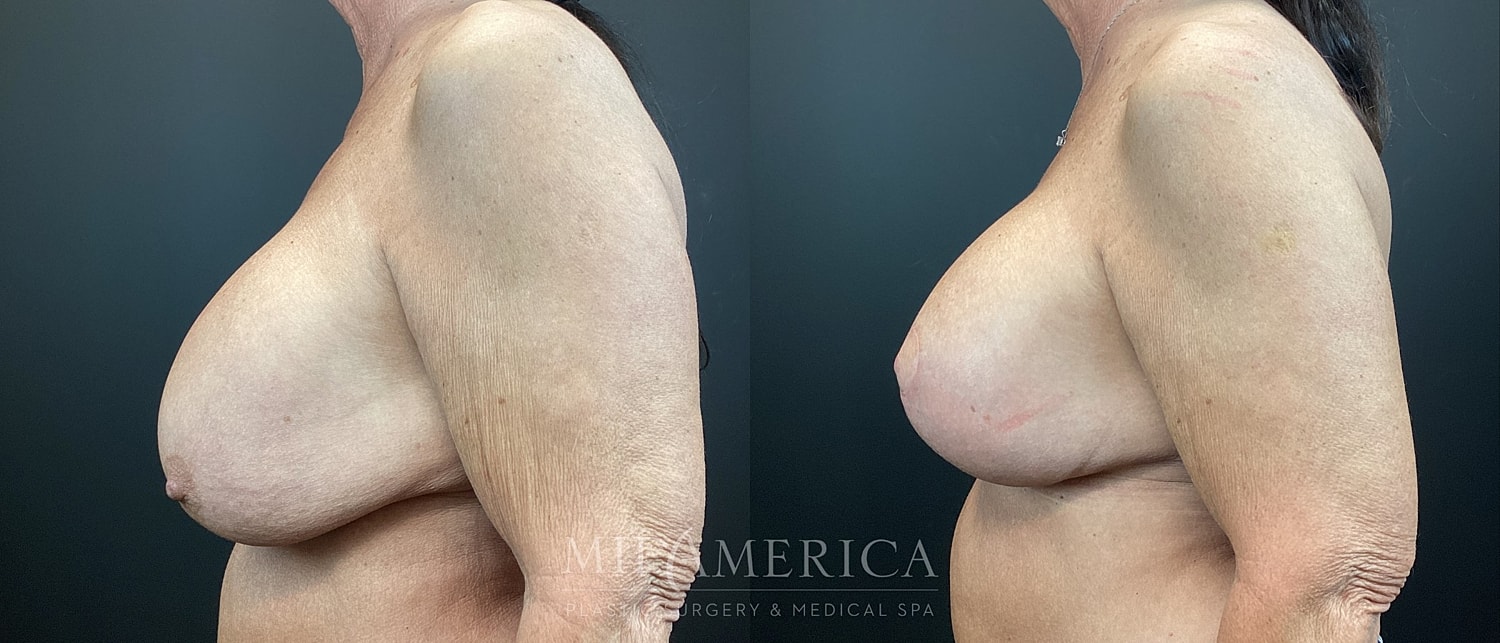 Implant Exchange Before & After