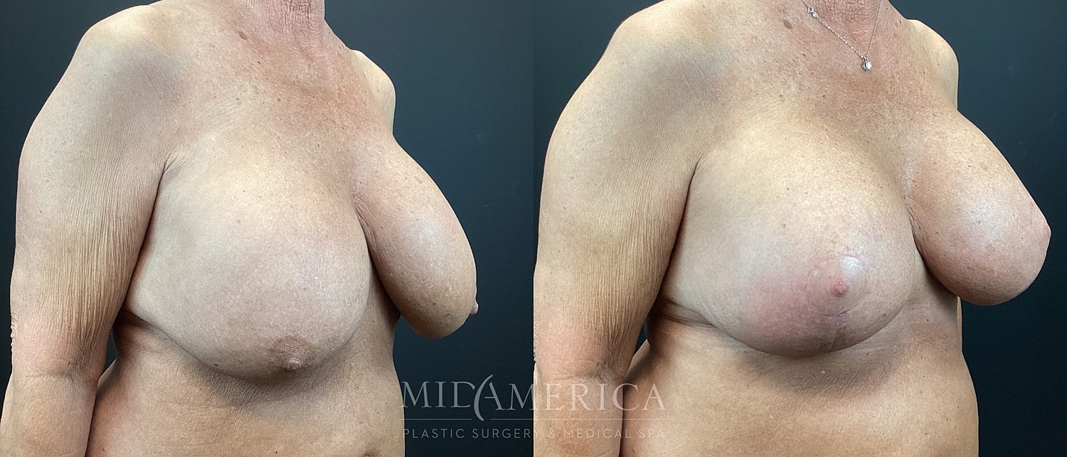 Implant Exchange Before & After