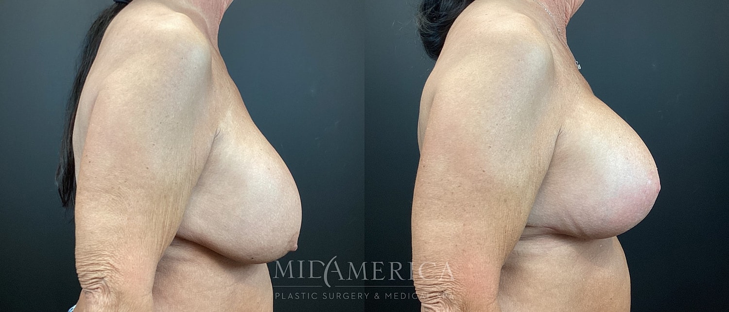 Implant Exchange Before & After