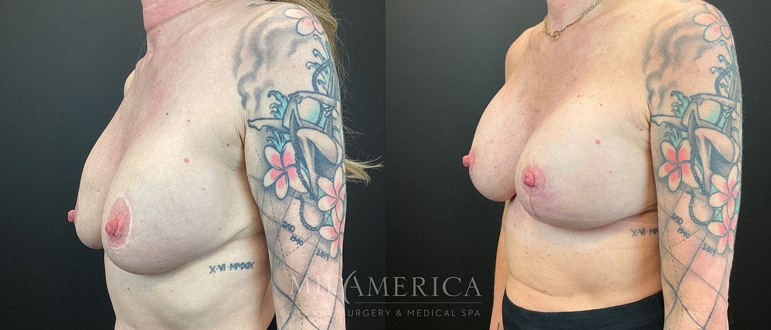 Implant Exchange Before & After
