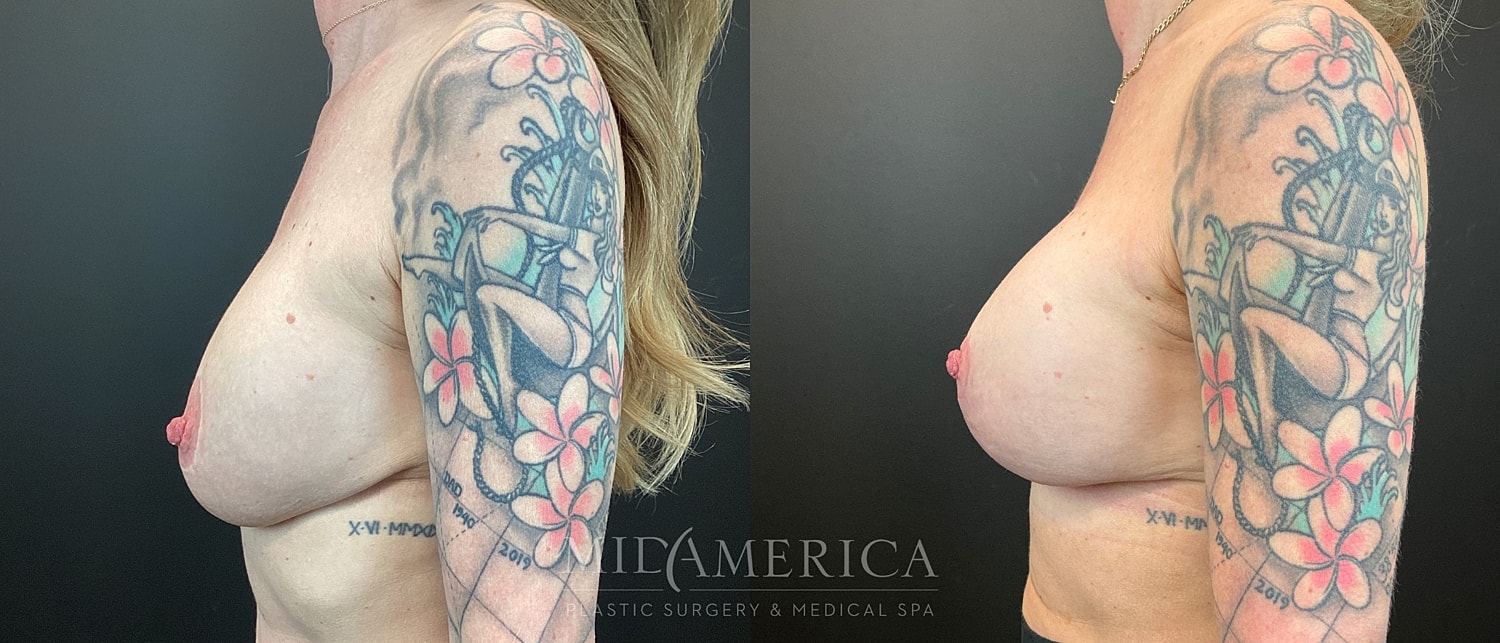 Implant Exchange Before & After