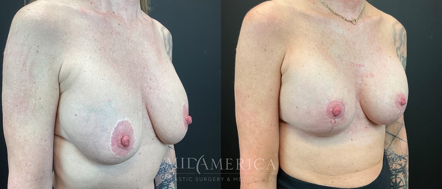Implant Exchange Before & After