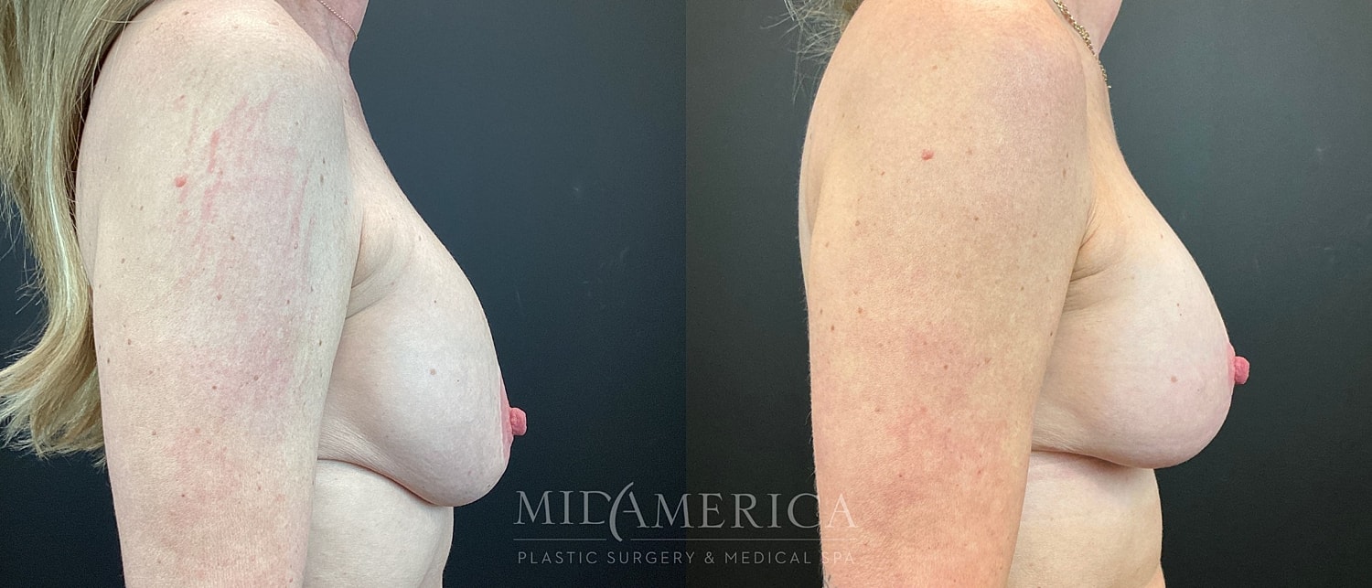 Implant Exchange Before & After