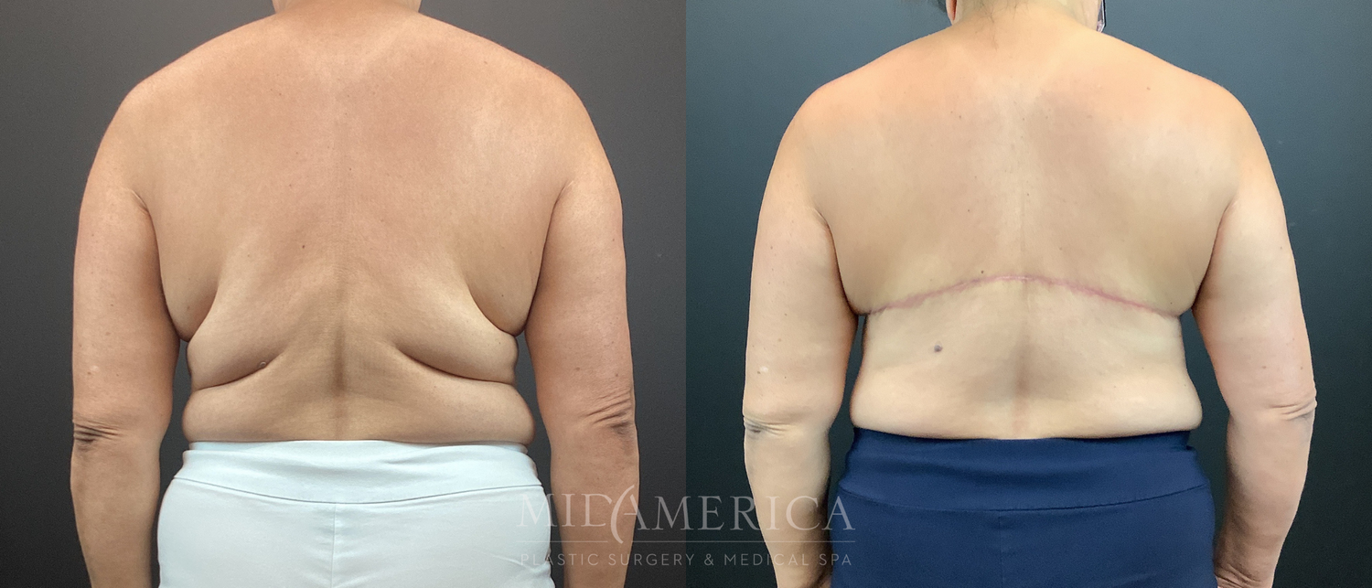 Bra Roll Excision Before & After