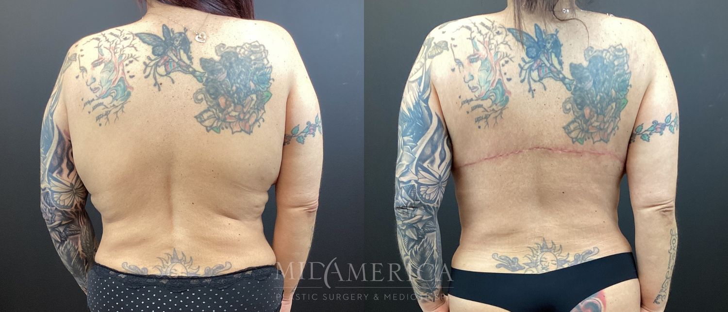 Bra Roll Excision Before & After