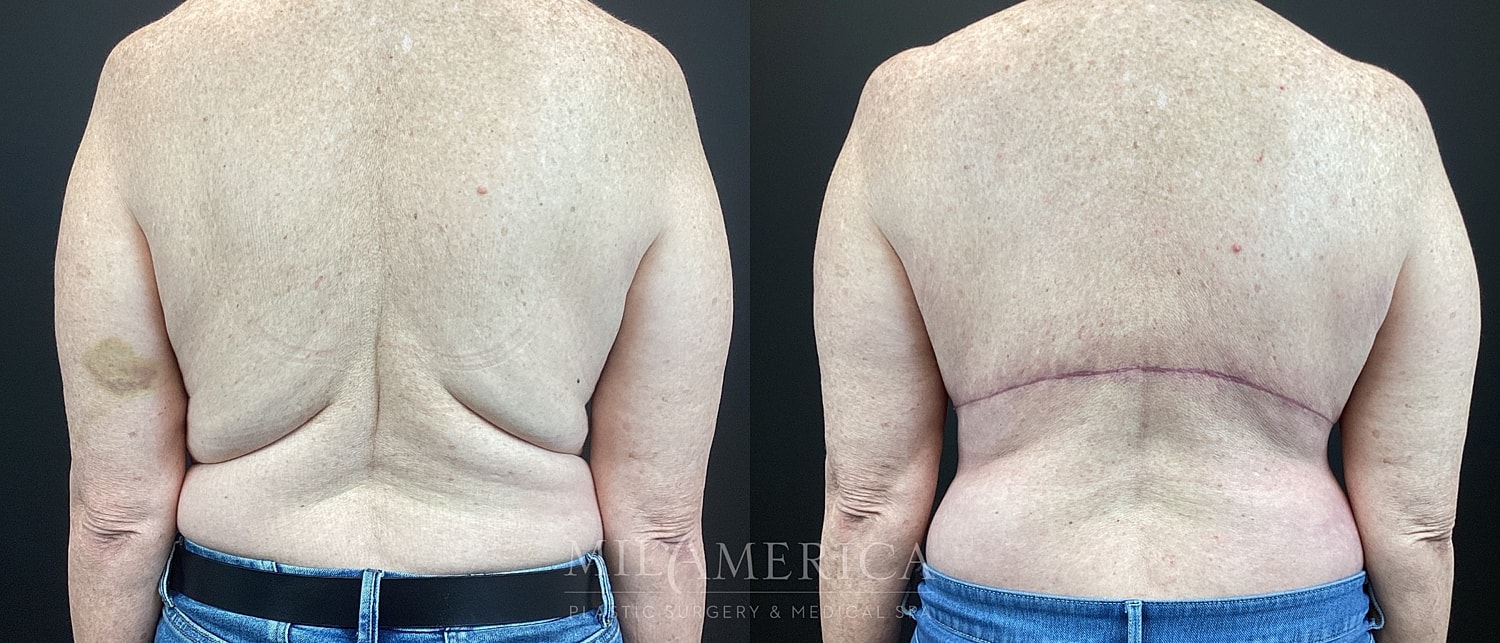 Bra Roll Excision Before & After