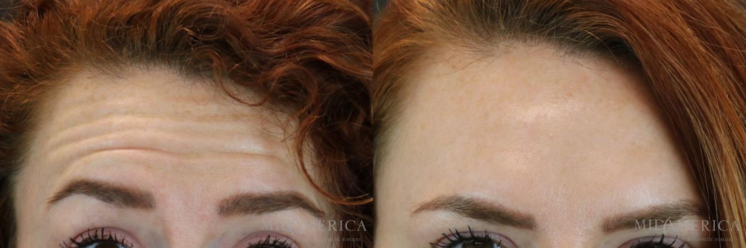 Botoxdysport Before & After