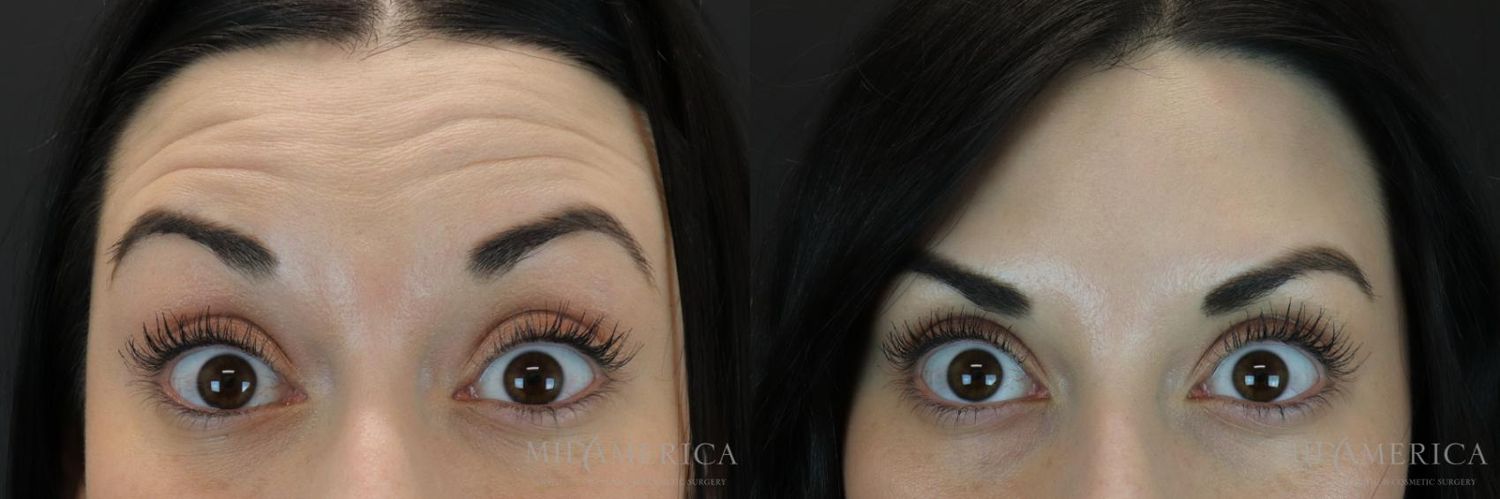 Botoxdysport Before & After