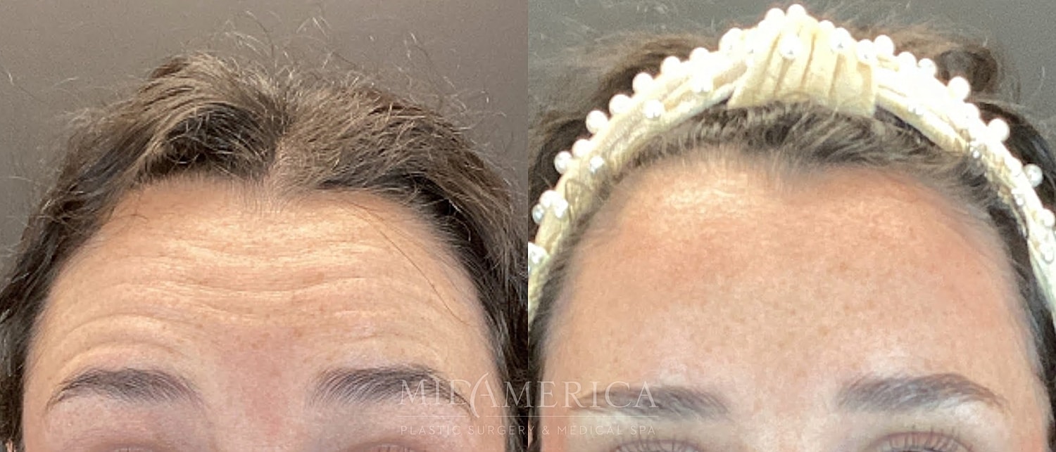 Botox Dysport Before & After