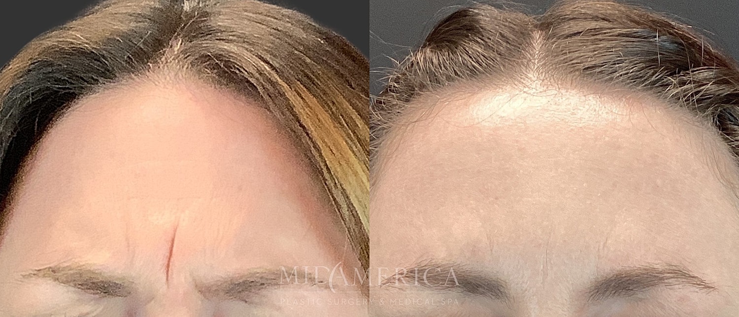 Botox Dysport Before & After