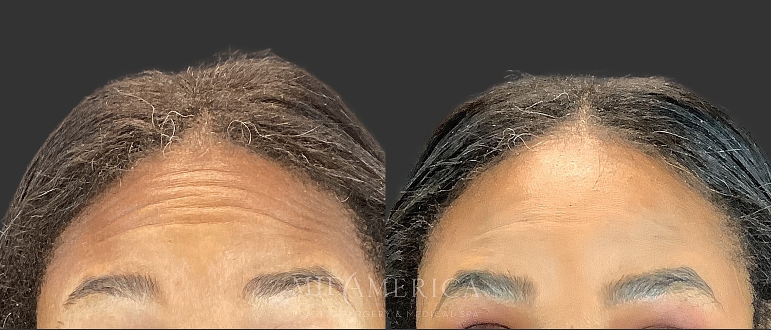 Botox Dysport Before & After