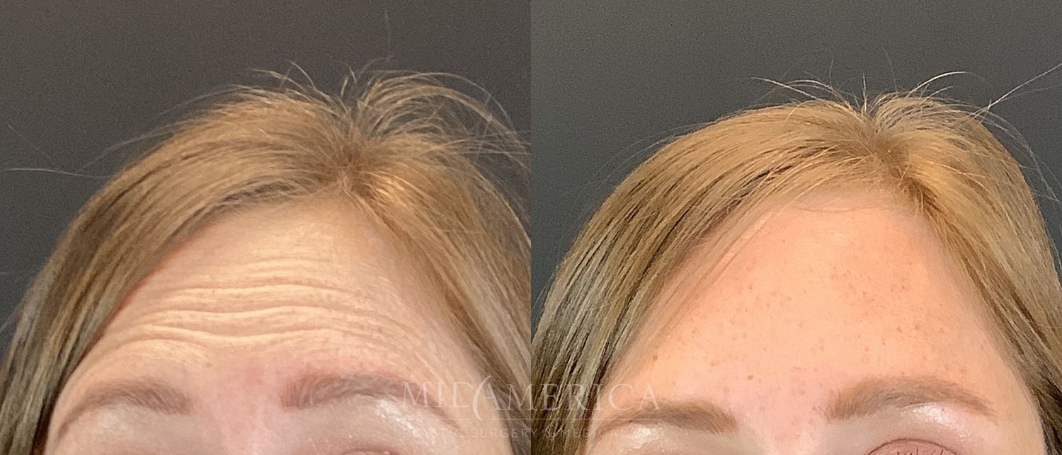 Botox Dysport Before & After