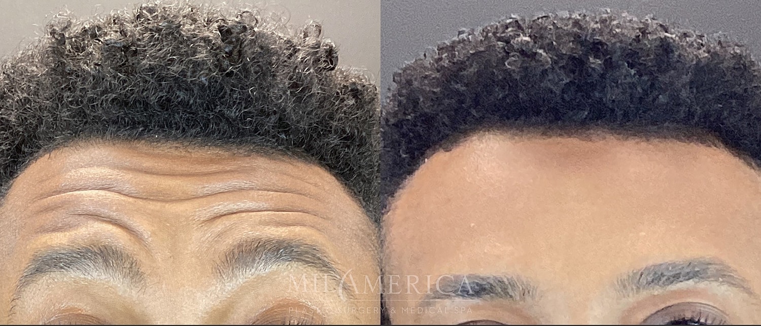 Botox Dysport Before & After