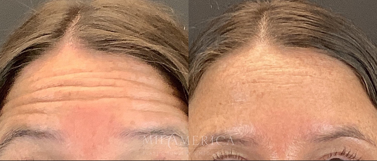 Botox Dysport Before & After
