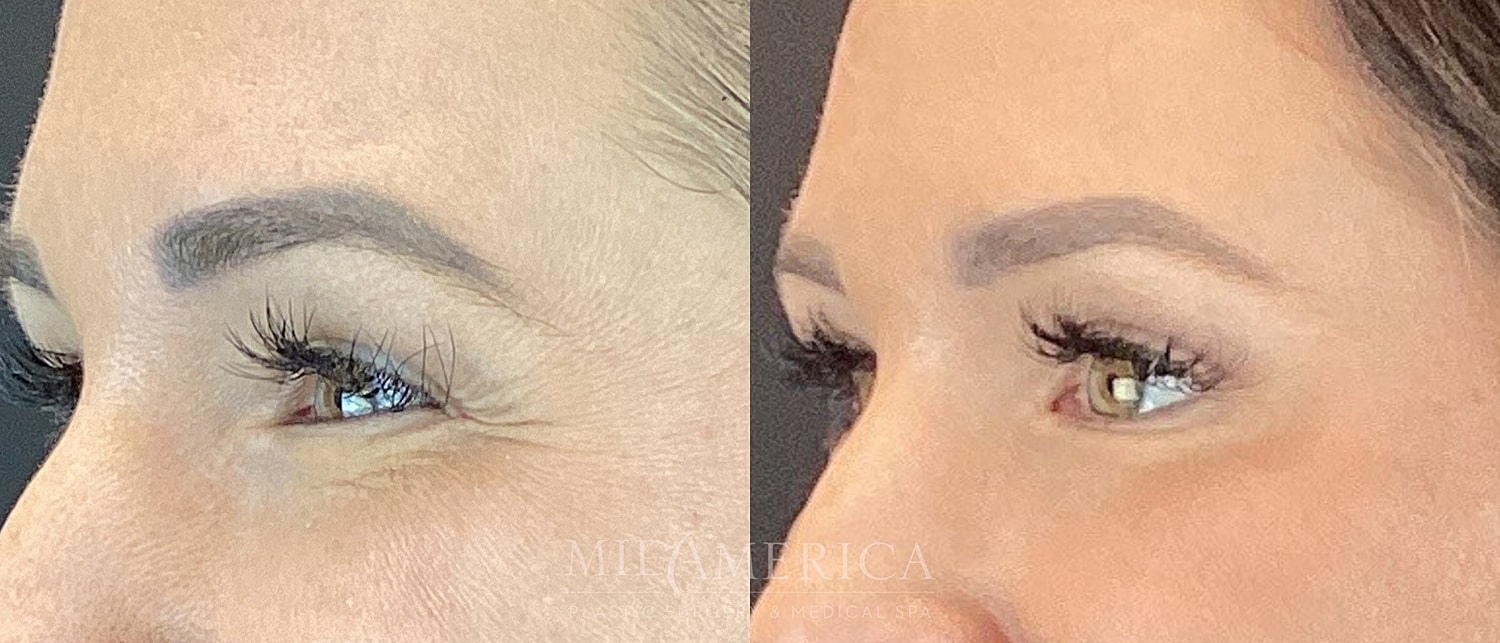 Botox Dysport Before & After
