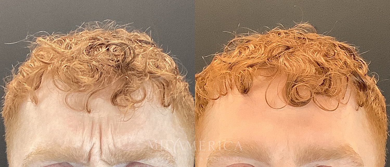 Botox Dysport Before & After