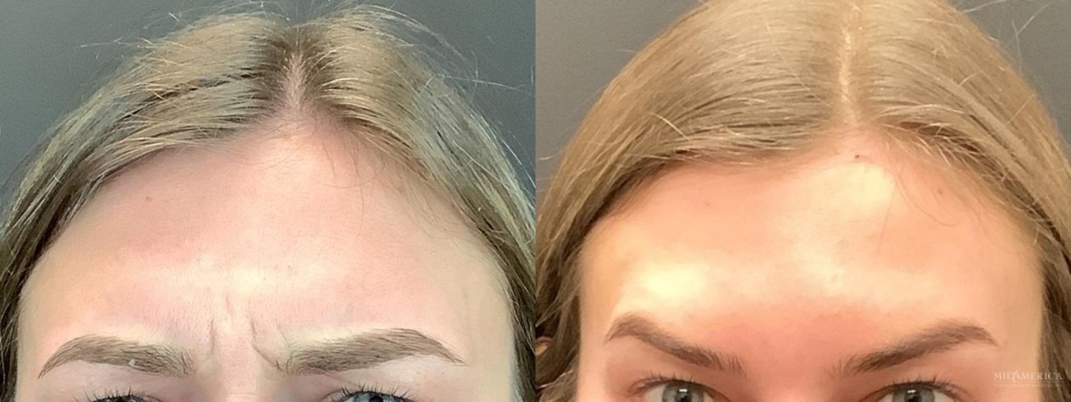 Botoxdysport Before & After
