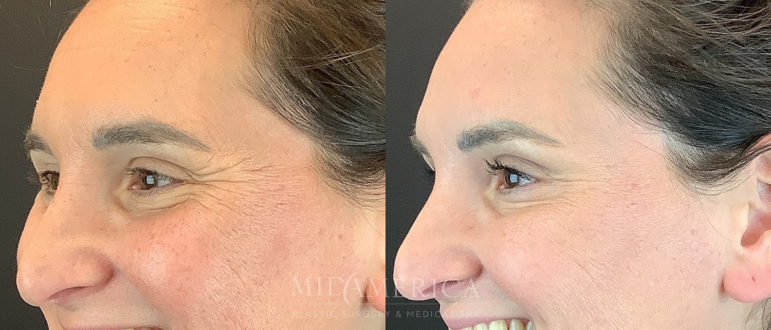 Botox Dysport Before & After