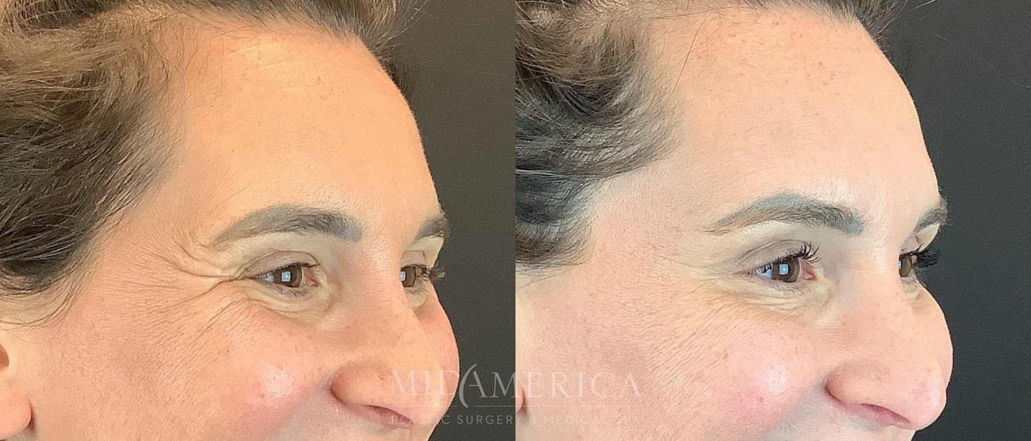 Botox Dysport Before & After