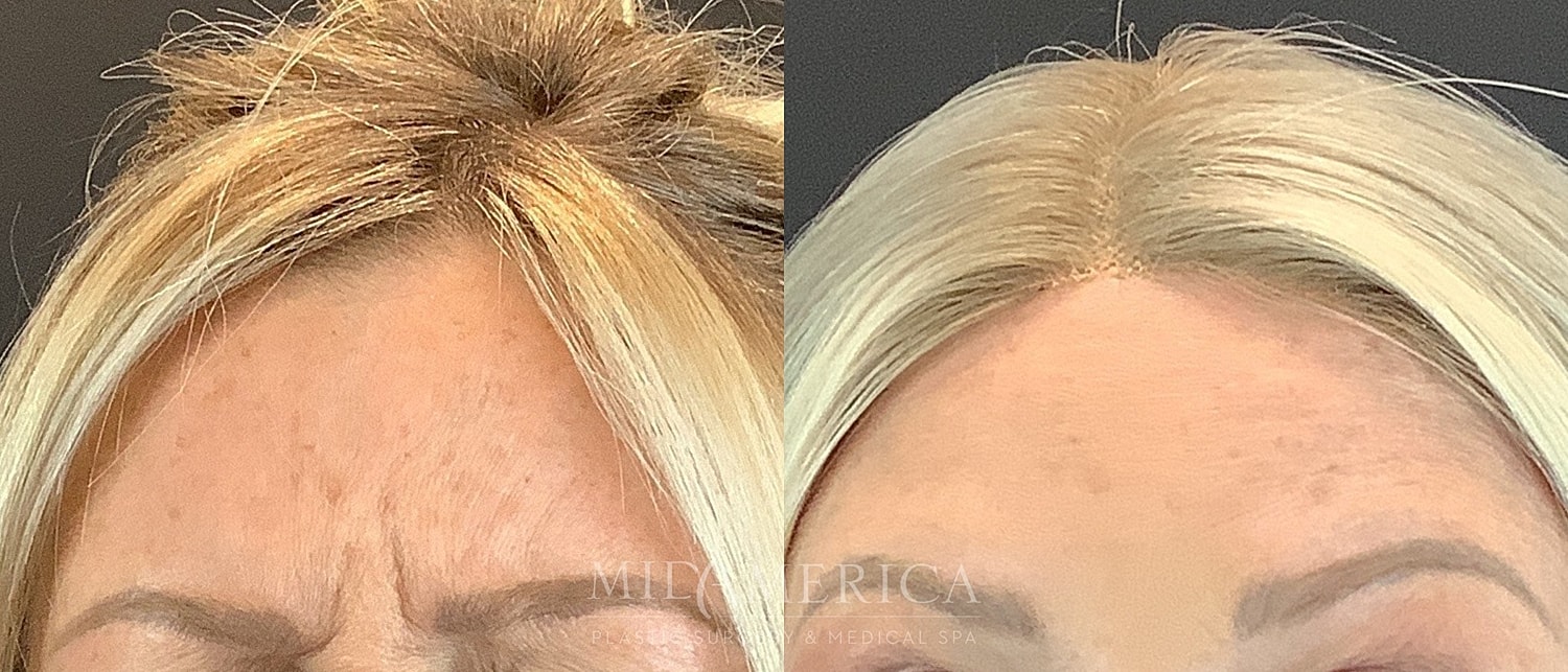 Before and after hair restoration comparison.