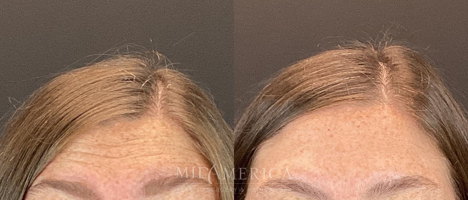 Before and after hair treatment comparison image.