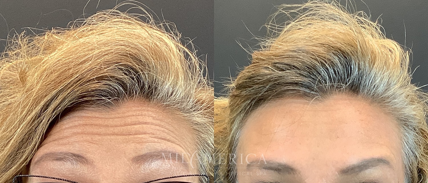 Botox Dysport Before & After