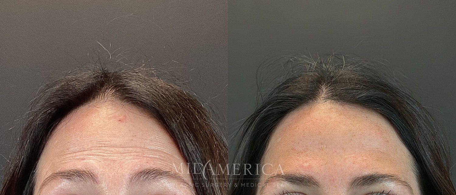 Botox Dysport Before & After