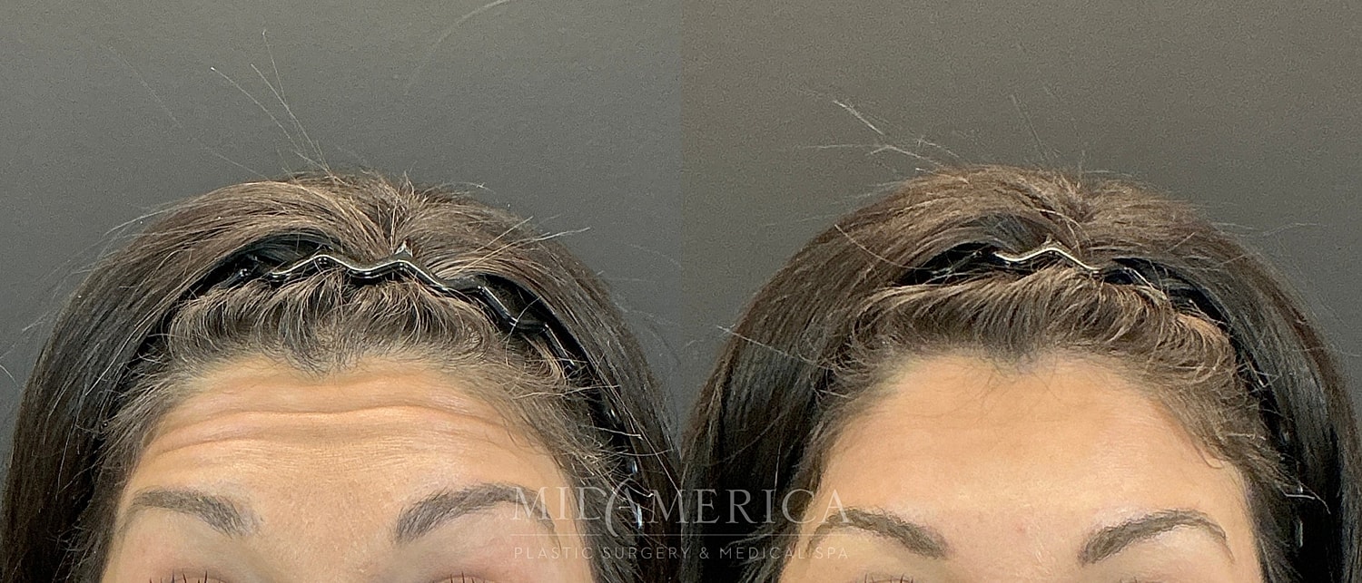Botox Dysport Before & After