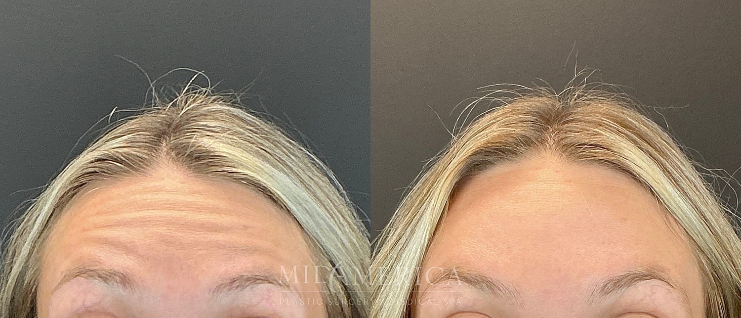 Botox Dysport Before & After
