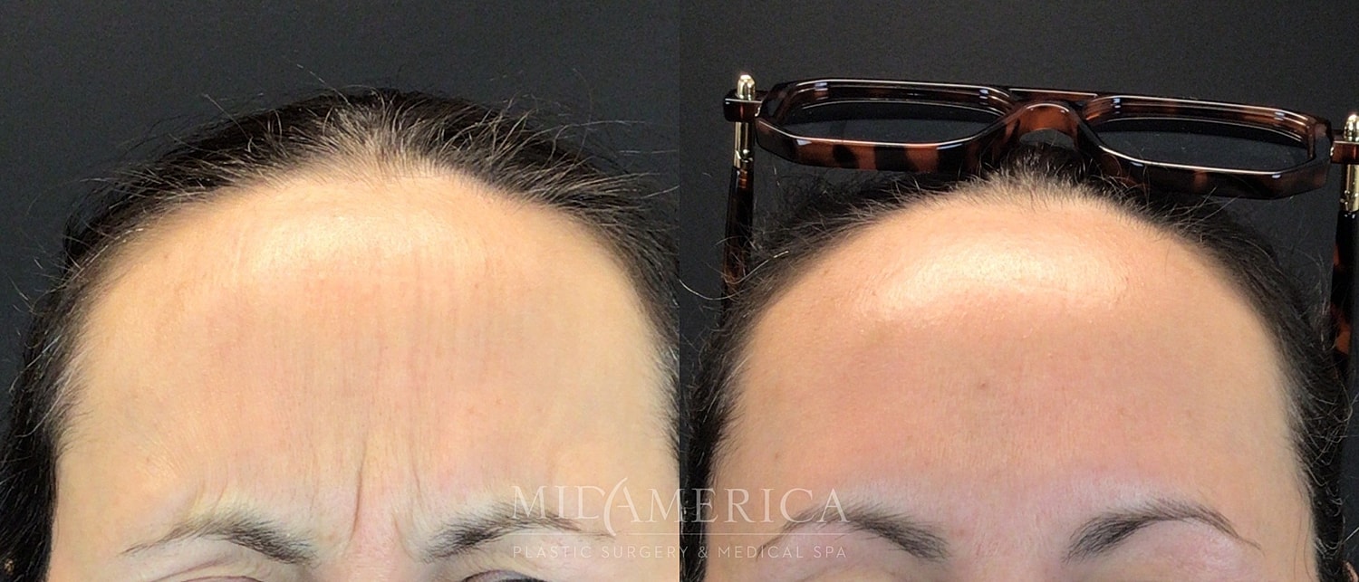 Botox Dysport Before & After