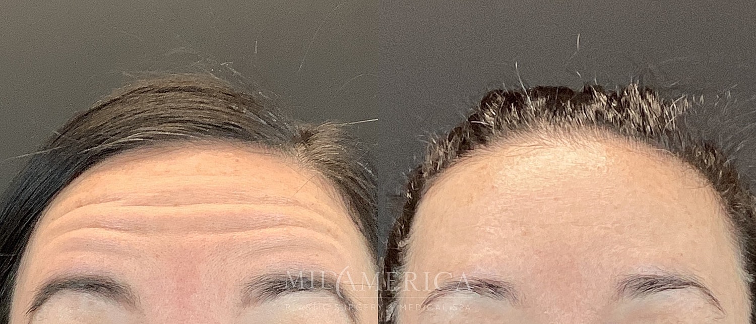 Botox Dysport Before & After