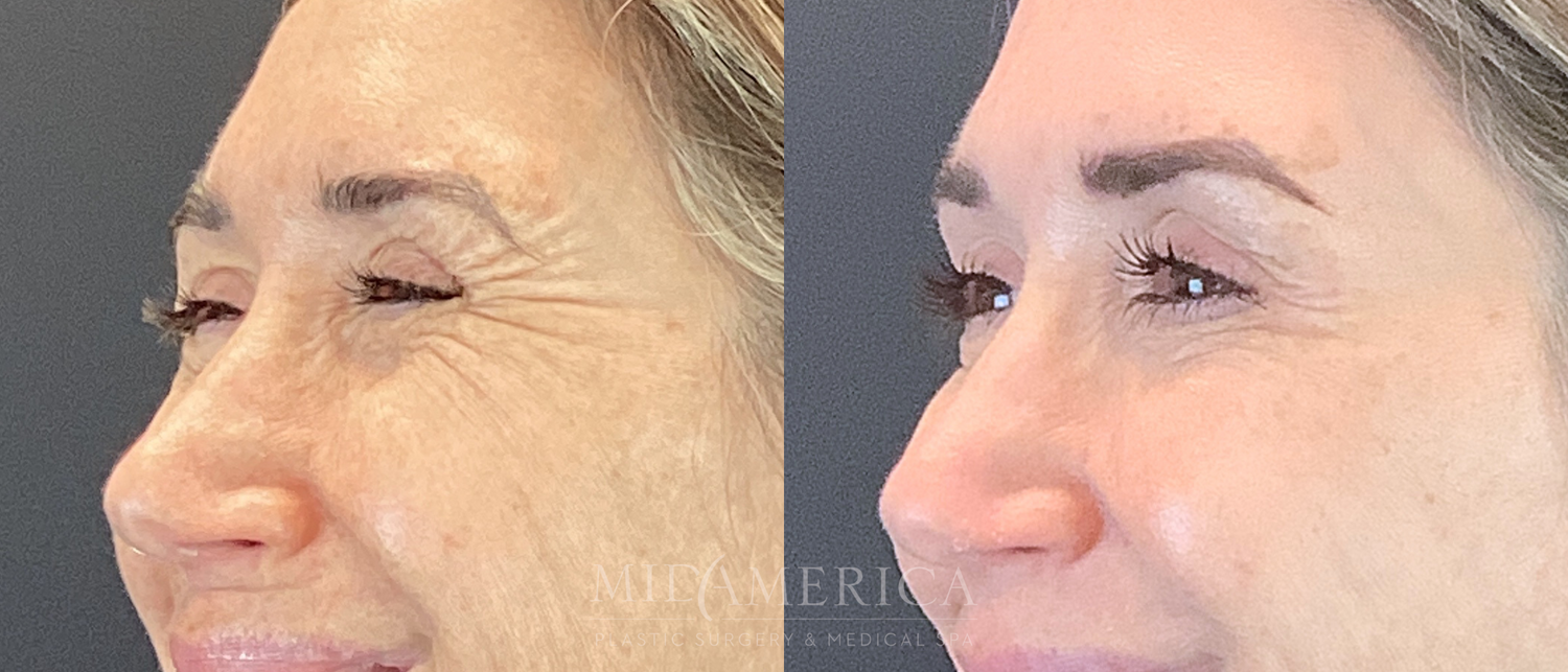 Botox Dysport Before & After