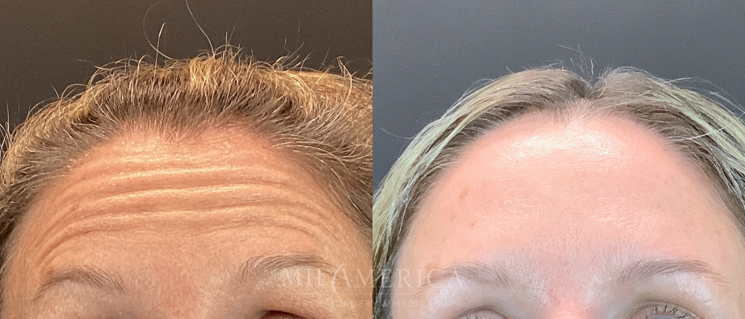 Botox Dysport Before & After