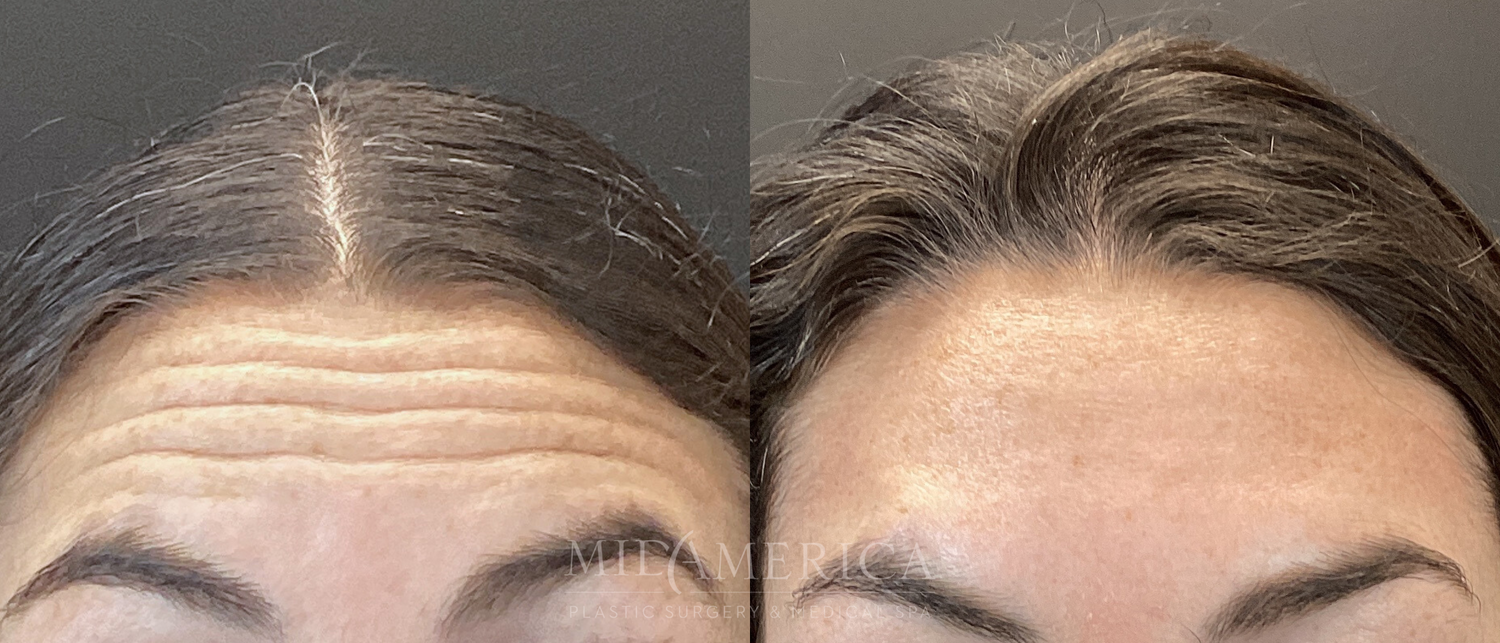 Botox Dysport Before & After
