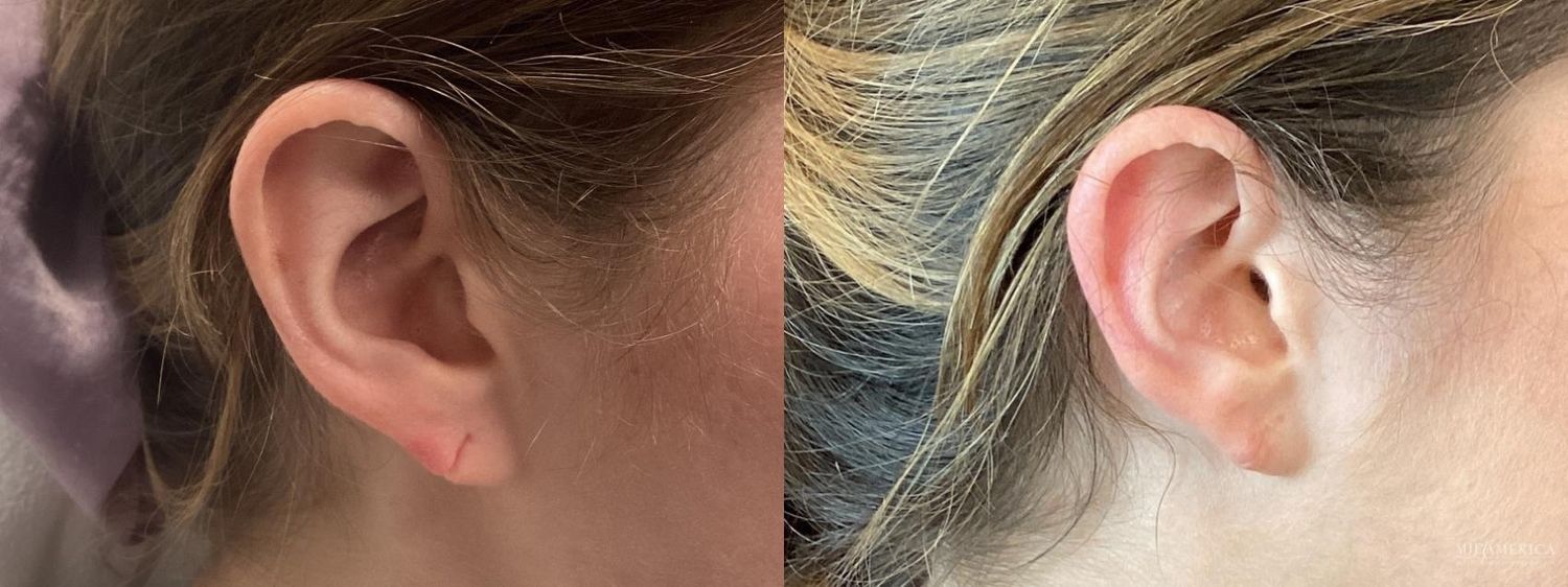 Earlobe Repair Before & After