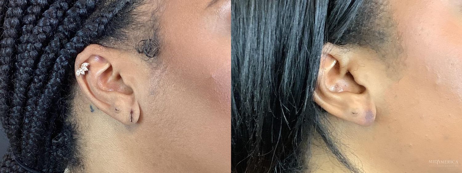 Earlobe Repair Before & After