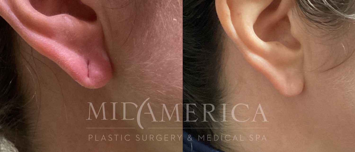 Earlobe Repair Before & After