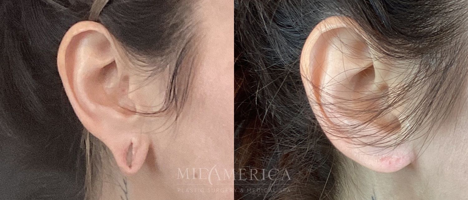 Earlobe Repair Before & After