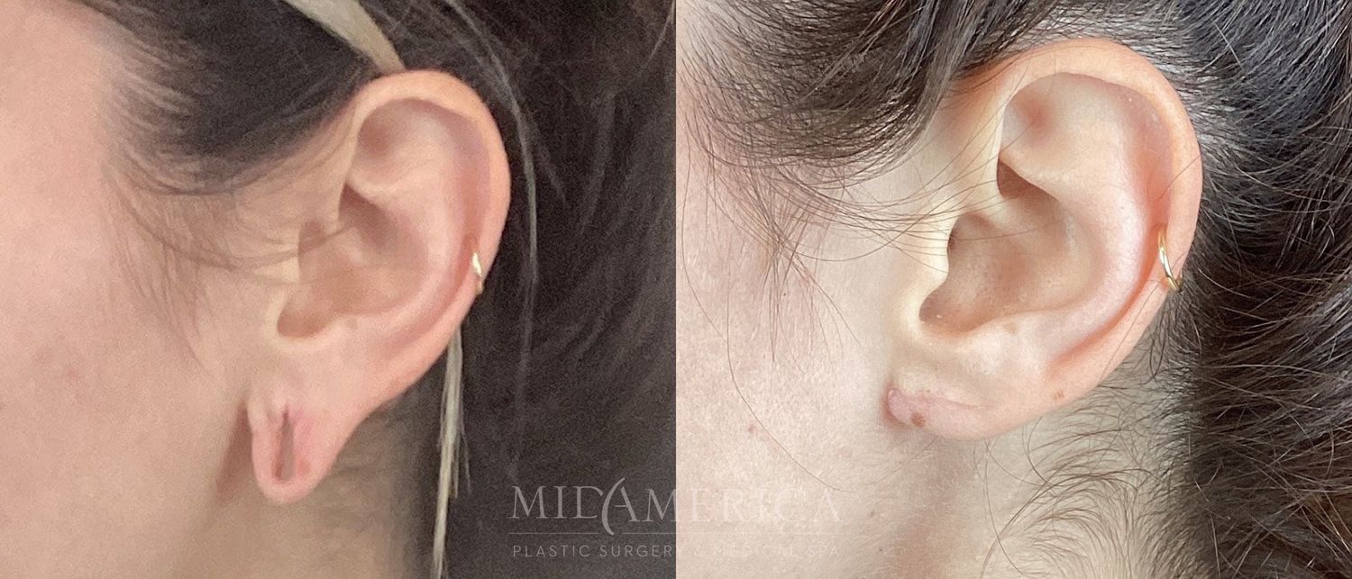 Earlobe Repair Before & After