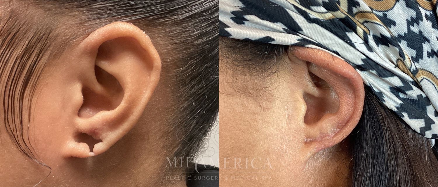 Earlobe Repair Before & After